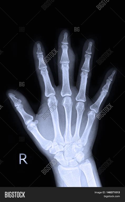 Xray Right Hand Finger Image And Photo Free Trial Bigstock