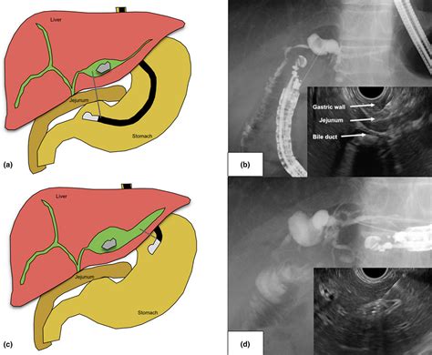 Endoscopic Ultrasonography‐guided Hepaticogastrostomy With Novel Two