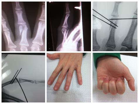 Finger Fracture Treatment With Percutaneous Pins John Erickson Md