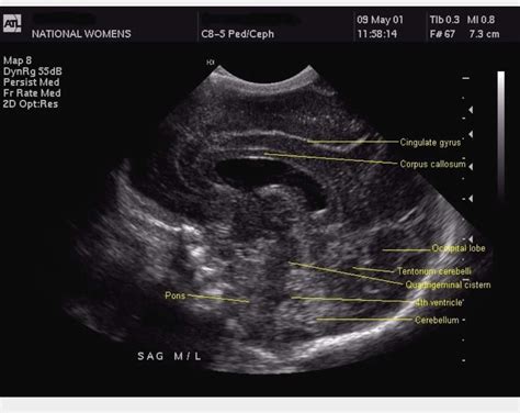 Fetal Ultrasound Ultrasound School Intracranial Hemorrhage Obstetric