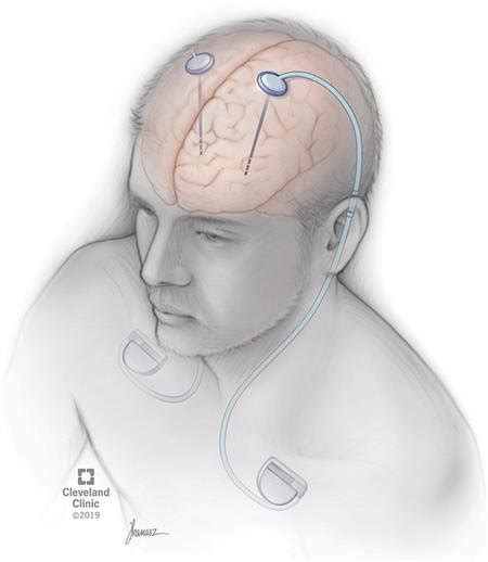 Surgical Procedure For Parkinsons Disease