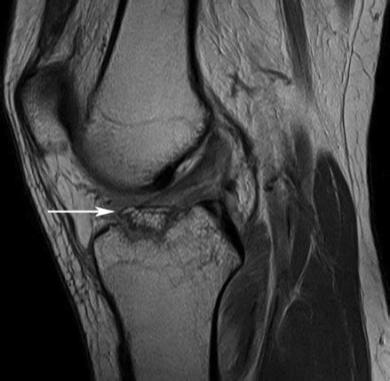 What is a spinal fracture? Tibial Spine Avulsion - The Emergency Physio