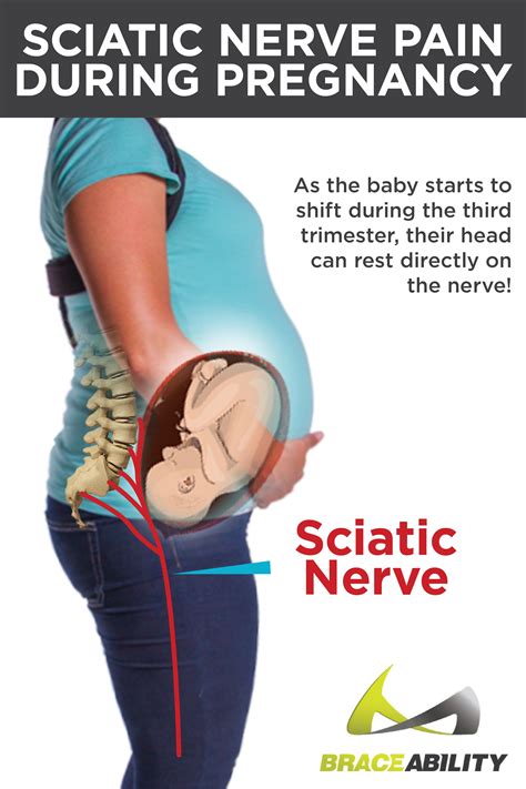 What Helps Sciatic Nerve Pain During Pregnancy Pregnancywalls
