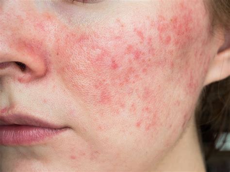 Everything You Need To Know About Rosacea Chatelaine