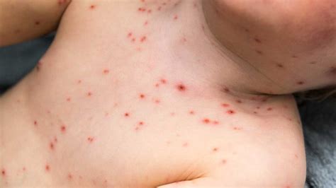 Bumps On Chest Small Red Rashes Acne Vulgaris And