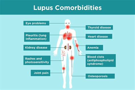 Lupus Complications What Lupus Patients Need To Know Free Nude Porn