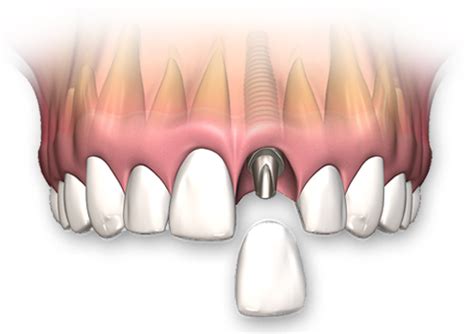 Single Tooth Dental Implants