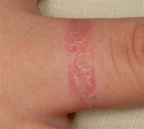 Ring Rash Causes Symptoms And Treatment