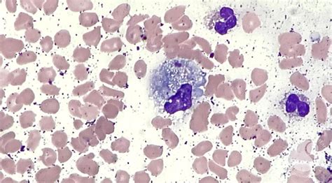 Peripheral Blood Smear Shows A Circulating Histiocyte