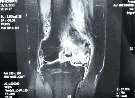 Avascular Necrosis Of The Knee Joint Dr Hc Chang