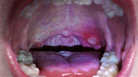 Giant Afta Canker Sores Aphthous Stomatitis Mouth Ulcer Aftab Youtube