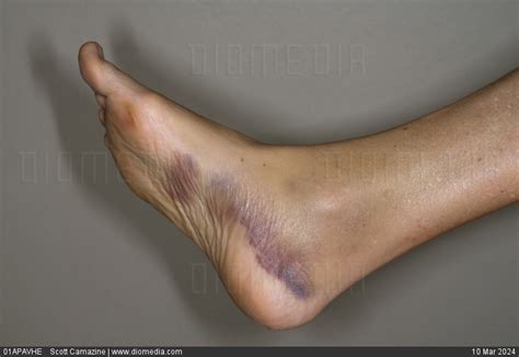 Stock Image Ecchymosis Bruising On The Right Foot Of A 56 Year Old