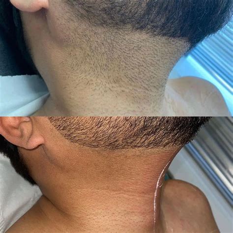 Why Laser Beard Shaping Or Full Beard Removal Is Now A Thing