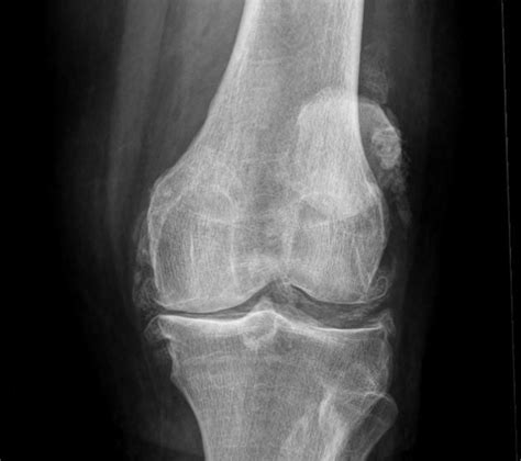 Cppd Of The Knee Radiology Case Radiology