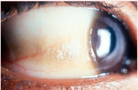 What Is An Eye Cyst Types Of Conjunctival Cystic Diseases