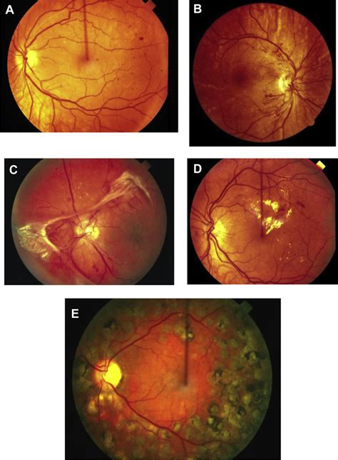 Funduscopic Features Of Different Stages Of Dr And Panretinal