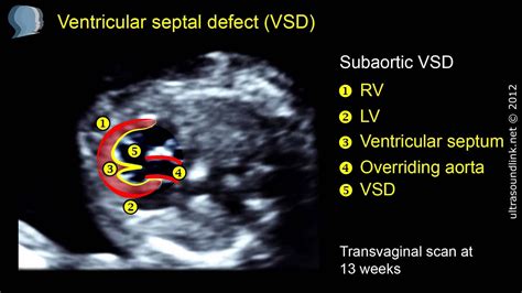 Ventricular Septal Defect Vsd Difficult Diagnosis Youtube