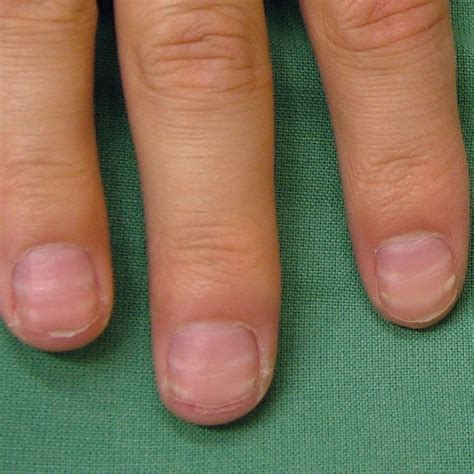 12 Ways To Get Rid Of Fingernail Ridges Per Dermatologists Ph
