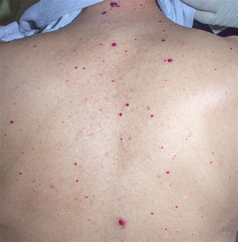 An Eruption Of Dome Shaped Red Papules The Bmj