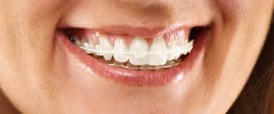 Which Cosmetic Braces Are Right For You The Online Dentist