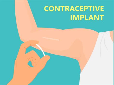 birth control implant nexplanon risks and side effects