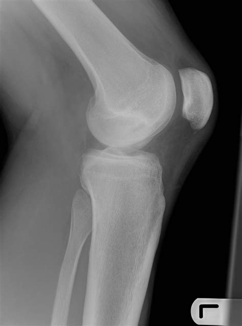 Osteochonditis Dysicans Ideas Avascular Necrosis Knee Surgery My XXX