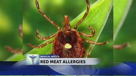 Doctors Note An Increase In Red Meat Allergies Due To Tick Bites Youtube