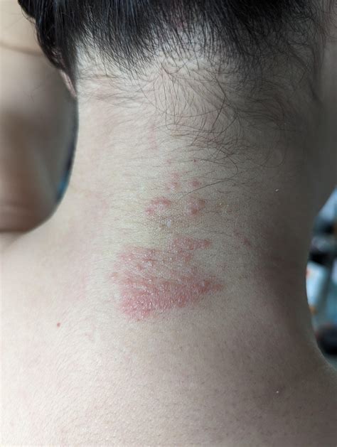 Womans Itchy Neck Rash Help Rdermatologyquestions