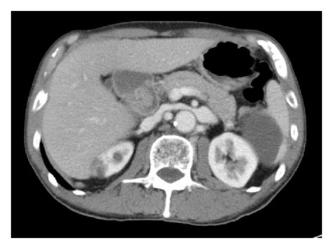 A There Are No Abnormal Findings In Abdominal Ct Scan