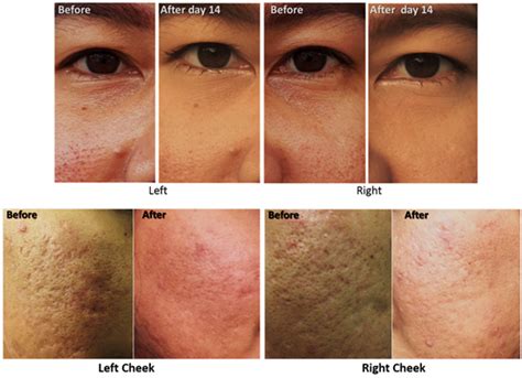 Improvement Of Atrophic Acne Scar And Skin Complexity By Combination Of