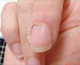 Fingernail Eczema Treatment
