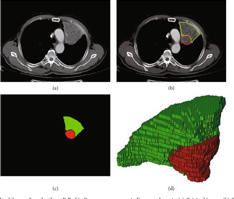 Figure 1 From Differentiating Central Lung Tumors From Atelectasis With