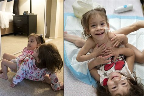 Conjoined Twins With Three Legs To Undergo Risky Separation Surgery
