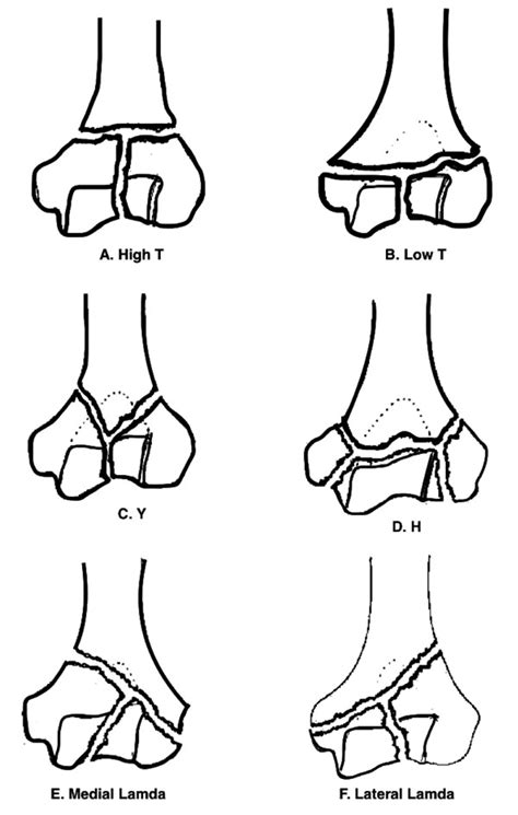 Challenges and Solutions in Management of Distal Humerus ...