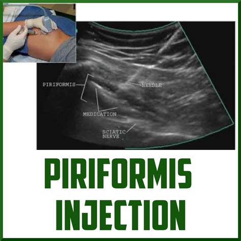 Piriformis Muscle Injection Procedure Sports Medicine Review