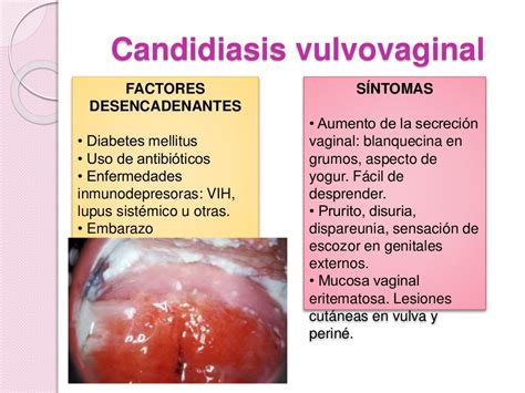 Vulvovaginitis