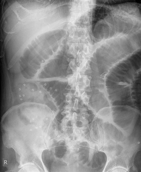 The Plain Radiograph Appearances Are Classical For A Distal Small Bowel