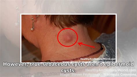How To Get Rid Of Epidermoid Cysts Remove Sebaceous Cyst Naturally