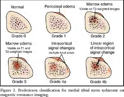 Figure 2 From Medial Tibial Stress Syndrome Semantic Scholar