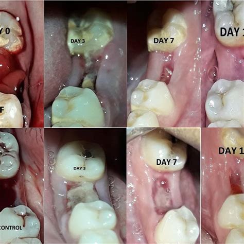 List 92 Pictures Day By Day Tooth Extraction Healing Pictures Superb