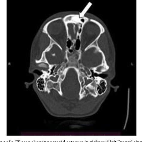 Figure 1 From Osteoid Osteoma Of The Frontal Sinus A Case Report