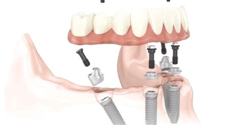 Solace Oral Surgery All On 4 A Game Changer For Dental Implants Get