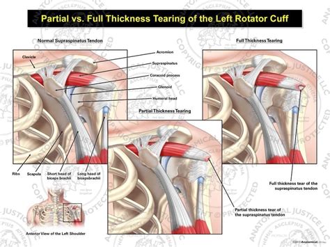 Partial Vs Full Thickness Tearing Of The Left Rotator Cuff