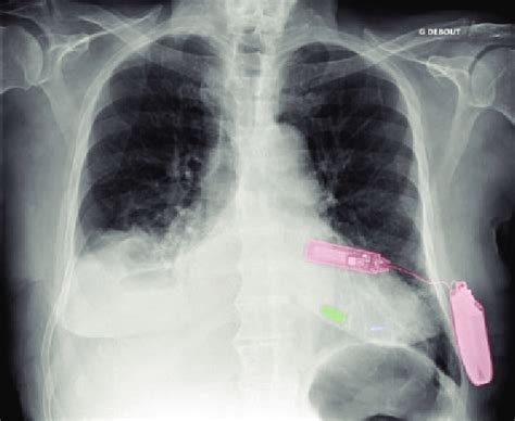 A Patient Chest X Ray Showing Both Micra And Wise Crt Systems Green