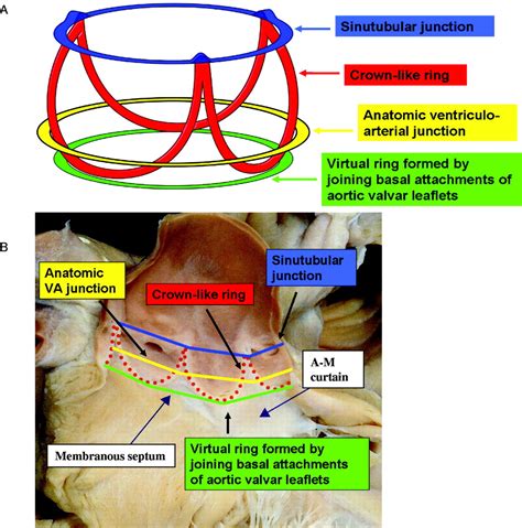 Anatomy Of The Aortic Valvar Complex And Its Implications For