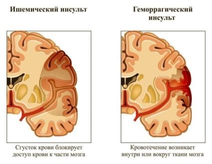 Tipuri De Accident Vascular Cerebral Hemoragic Cauze Simptome
