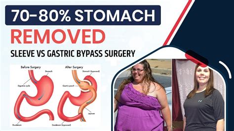 Sleeve Vs Bypass Surgery For Weight Loss Pros And Cons Of Your Stomach Removed