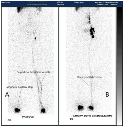 Radiation Free Full Text Lymphoscintigraphic Indications In The