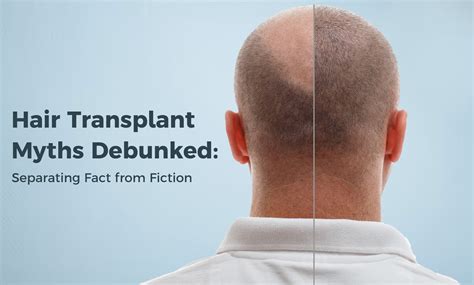 Hair-Transplant-Myths-Debunked-Separating-Fact-from-Fiction | Nova