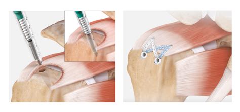 Rotator Cuff Tear Repair